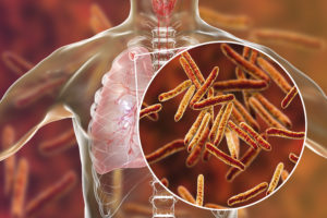 Secondary tuberculosis in lungs and close-up view of Mycobacterium tuberculosis bacteria, 3D illustration